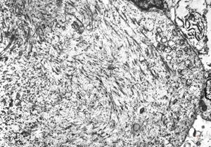 M,29y. | testis - embryonal rhabdomyosarcoma in teratoma M,29y. | testis - embryonal rhabdomyosarcoma in teratoma
